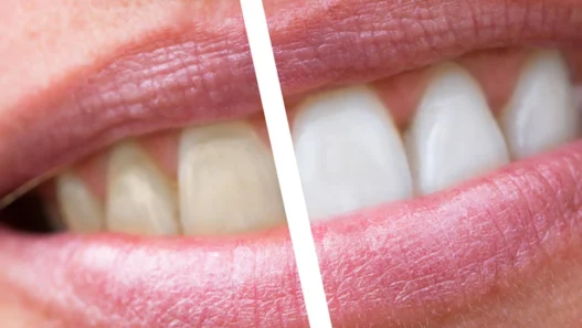 denti con tartaro