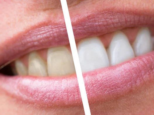 denti con tartaro