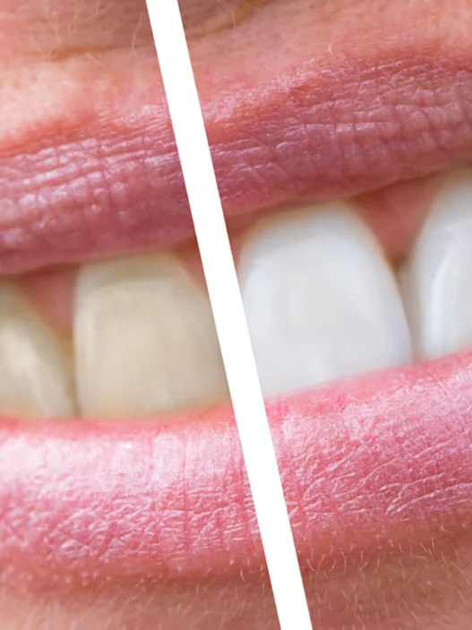 denti con tartaro