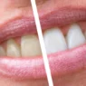 denti con tartaro